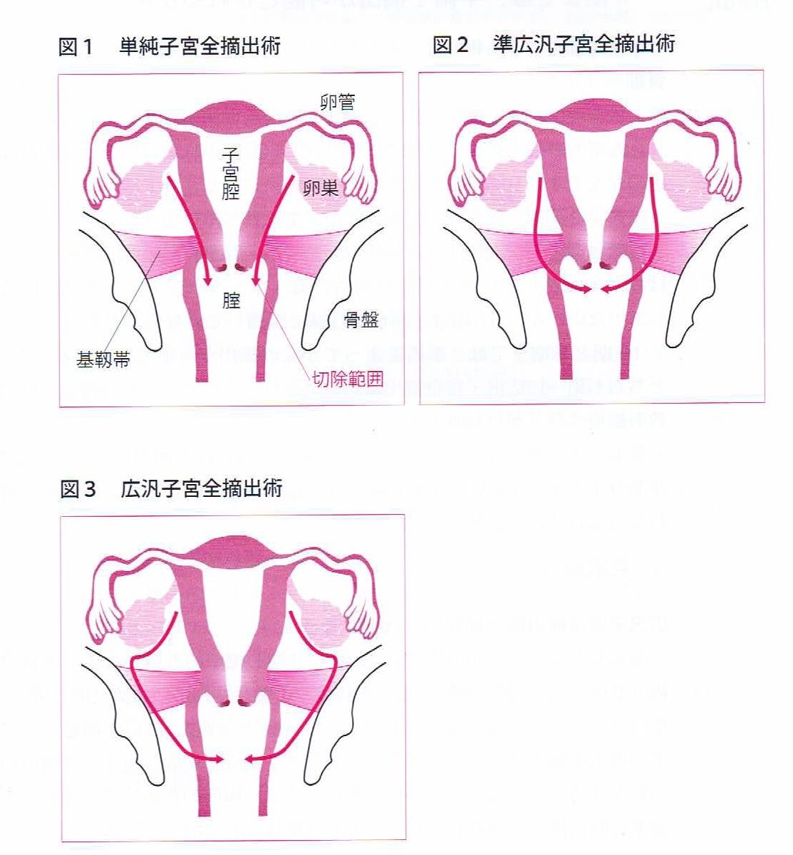 主な子宮悪性腫瘍手術の切除範囲模式図