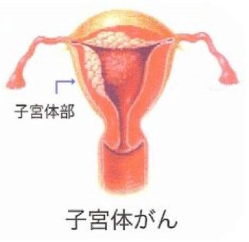 子宮体癌