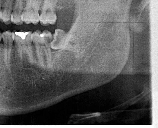 左下顎水平埋伏智歯の抜歯