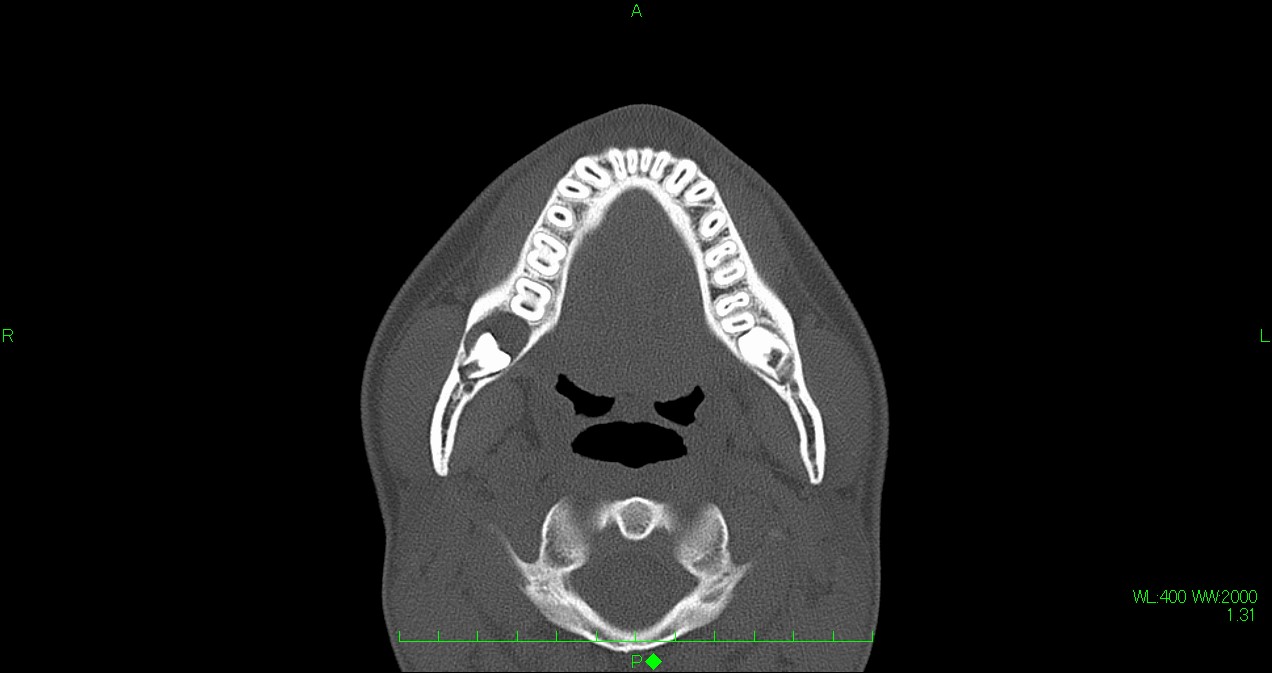 右下顎含歯性嚢胞のパノラマX線写真とCT写真