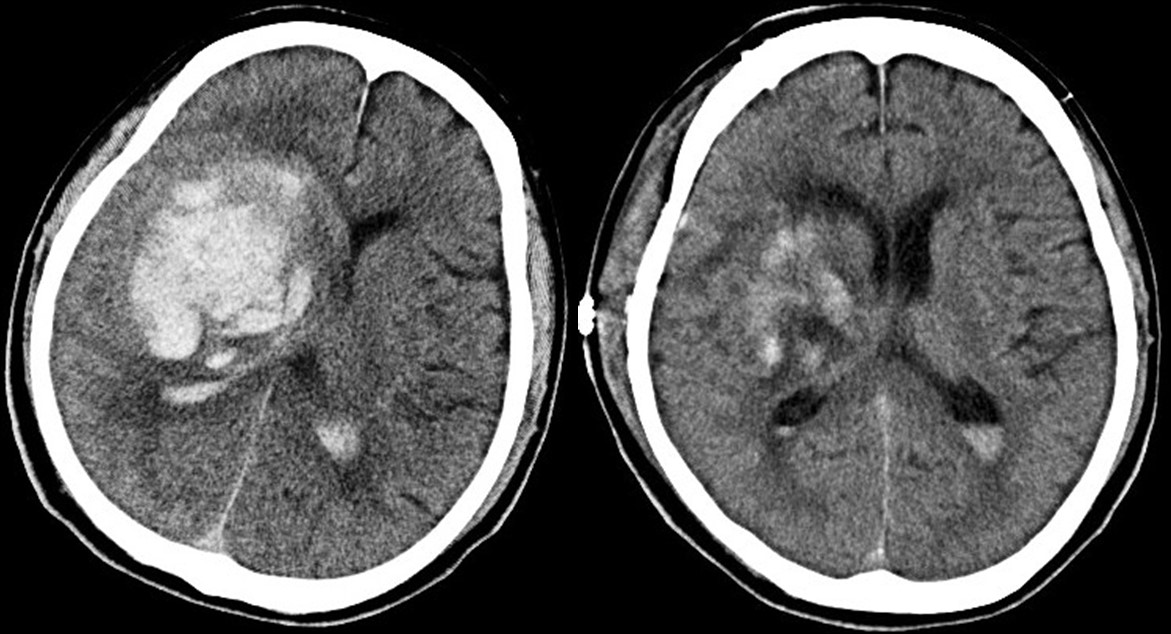 左：大きな脳内出血。　右：開頭術後、血腫は除去されている。