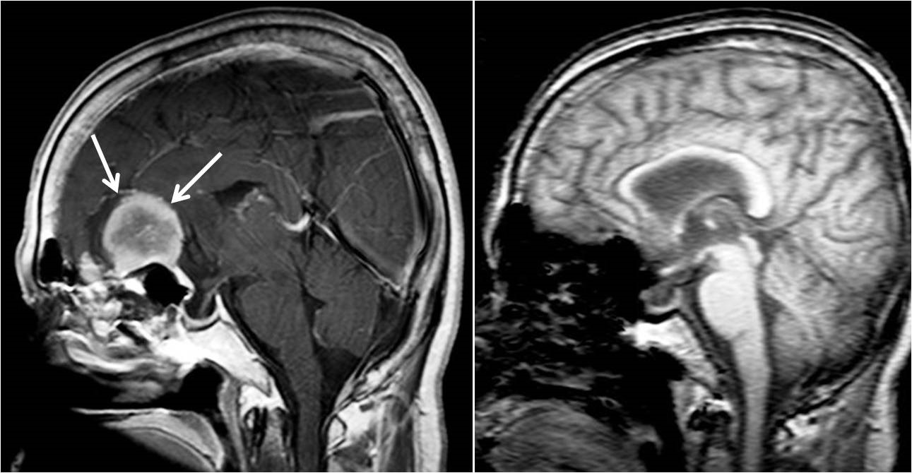 頭部を側面から見た前頭蓋底の大きな脳腫瘍（髄膜腫）。開頭手術により全摘出されている。左：術前、右：術後。