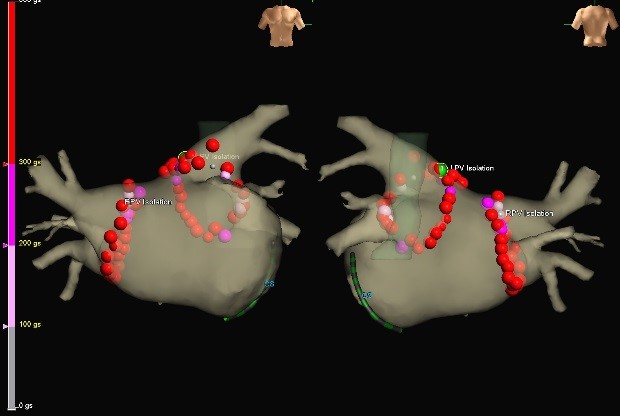3Dマッピングを用いた肺静脈隔離術