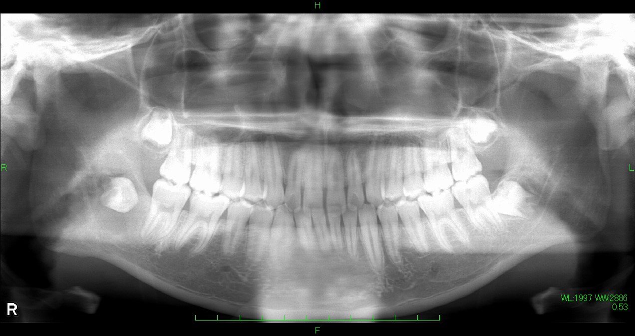 右下顎含歯性嚢胞のパノラマX線写真とCT写真