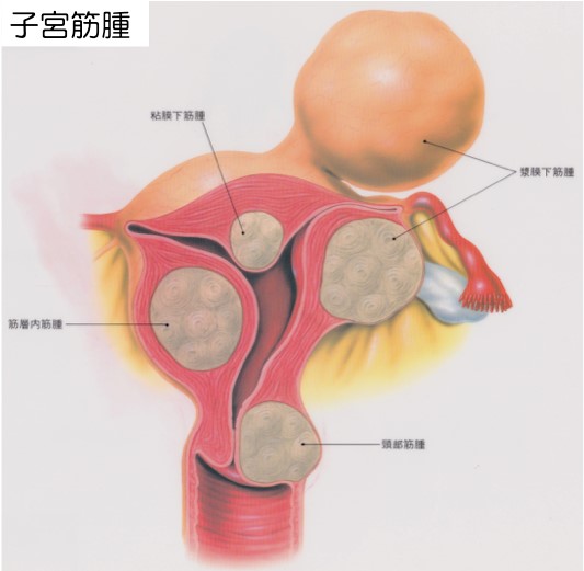 子宮筋腫