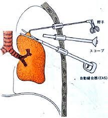 胸腔鏡手術のイメージ
