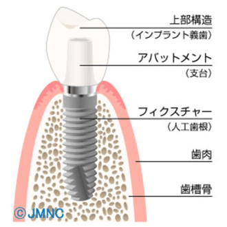 インプラントとは