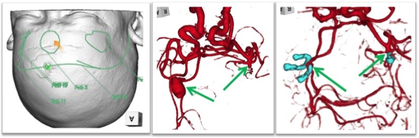 脳動脈瘤のクリッピング手術例。左：術前に手術の設計図を描き、治療のシミュレーションを行う。中：左右に２か所ある脳動脈瘤（矢印）。右：術後、脳動脈瘤はクリップで完全に遮断し、根治されている。