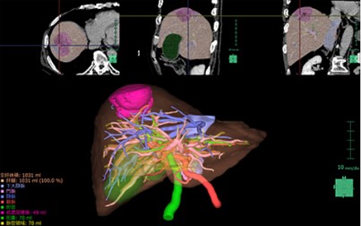 CT画像を用いた肝臓実質の3D画像 離断面表示などの手術シミュレーションに利用します。