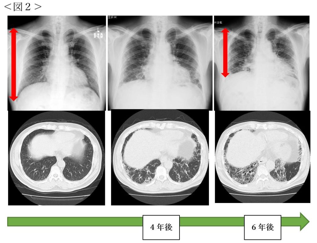 間質性肺炎をご存知でしょうか ｜ 公益財団法人 甲南会 甲南医療センター（旧）甲南病院