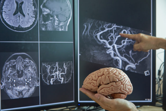 脳神経外科／未破裂脳動脈瘤治療について