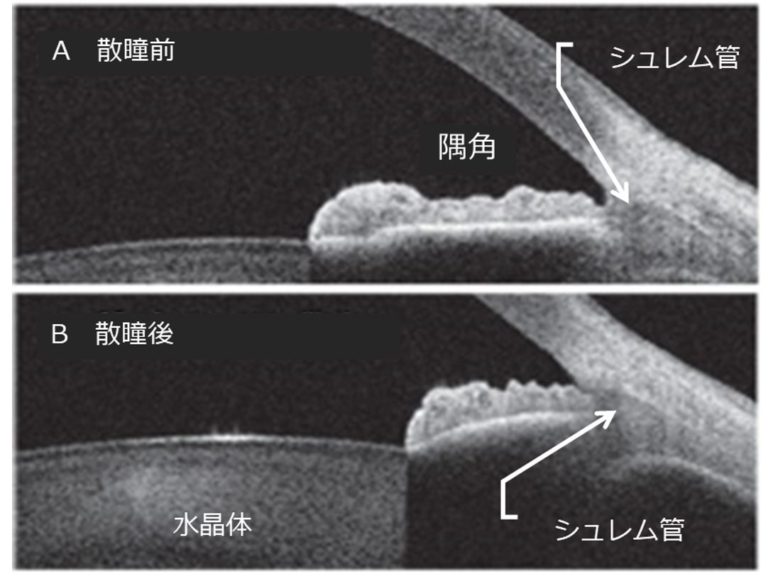 閉塞隅角緑内障の種類