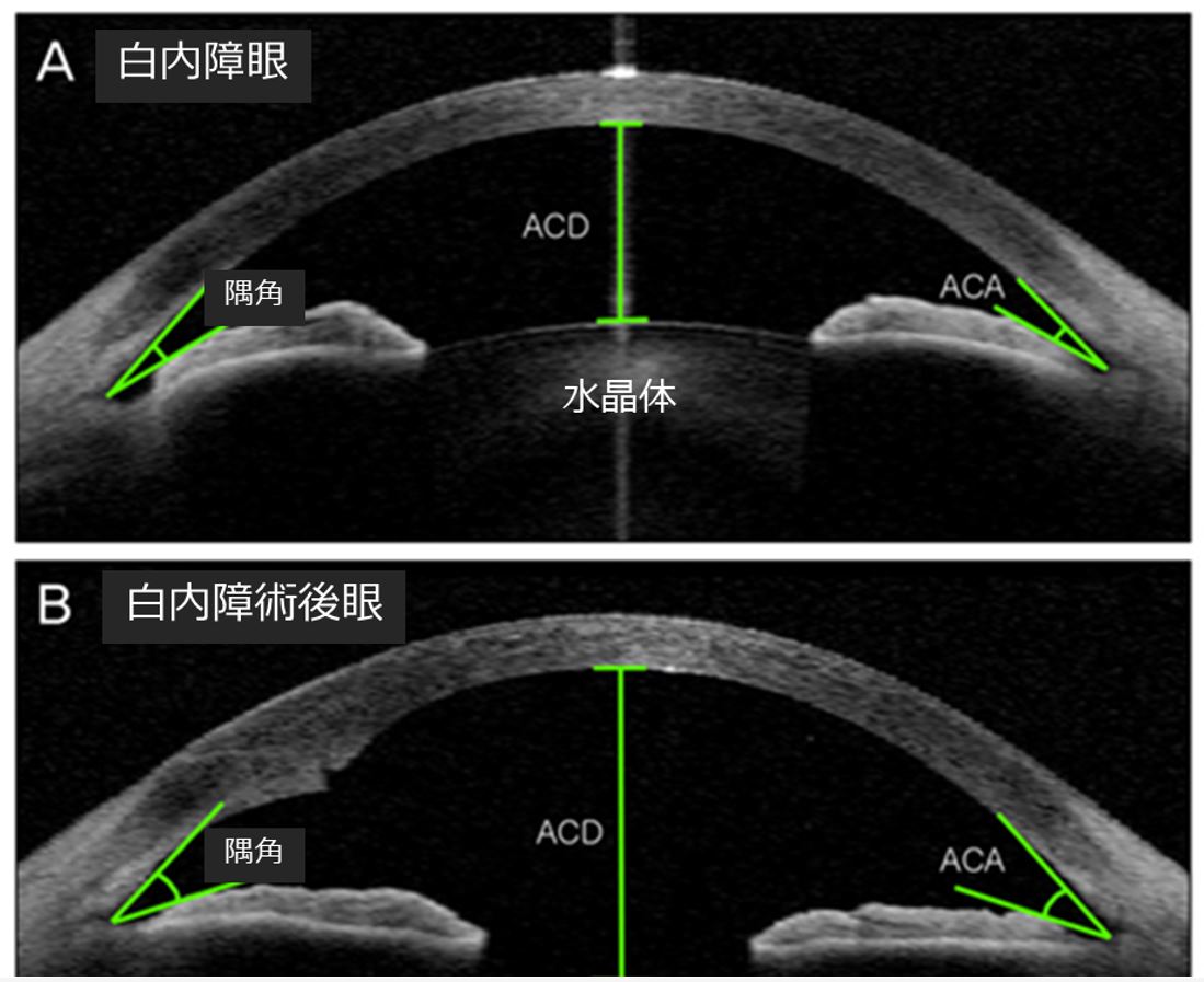 閉塞隅角緑内障の治療