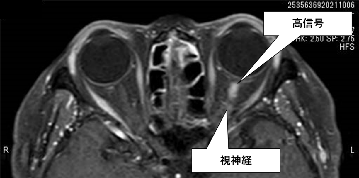 視神経周囲炎 mri | 視神経炎 ガイドライン – BWAYO
