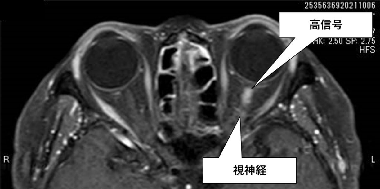 図２　抗アクアポリン4抗体陽性視神経炎症例の造影MRI像
