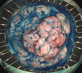 内視鏡的粘膜下層剥離術（ESD）により治癒切除となった6cm大の早期直腸がん