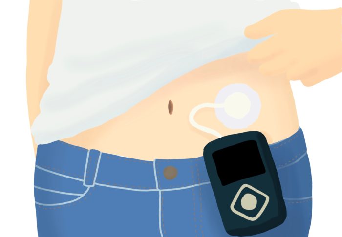 インスリンポンプの候補者は誰でしょうか?